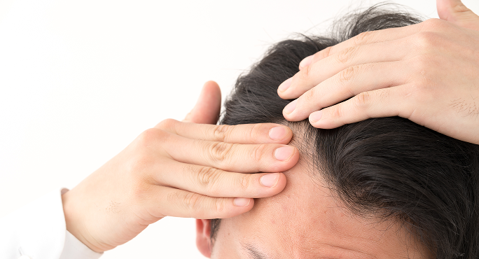 AGAの進行イメージ